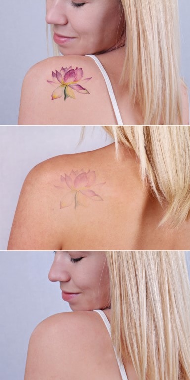 Laser Tattoo Removal - Freja Sophia Studio